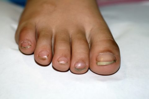 Spotlight on Surgery for Ingrown Toenails - Advanced Footcare Center